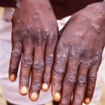 Mpox